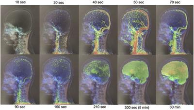 Frontiers | Dynamic 18F-FDG-PET Kinetic Parameters For Epileptogenic ...